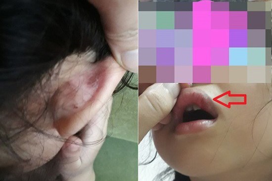 Hà Nội: Cô giáo tiểu học bị tố dùng tay, sách đánh học sinh chảy máu, dập môi tại trường học
