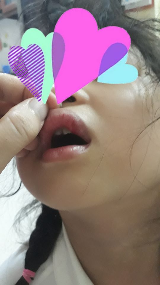 Vụ phụ huynh ở Hà Nội tố con gái bị đánh véo đến dập môi tụ máu, cô giáo giải thích Con tự cạy vảy ở môi-1