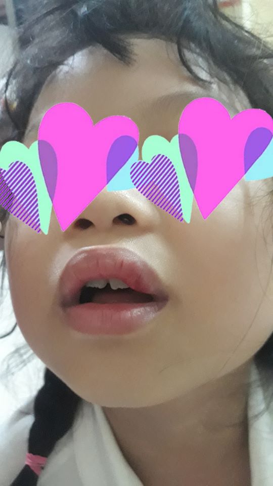 Vụ phụ huynh ở Hà Nội tố con gái bị đánh véo đến dập môi tụ máu, cô giáo giải thích Con tự cạy vảy ở môi-2