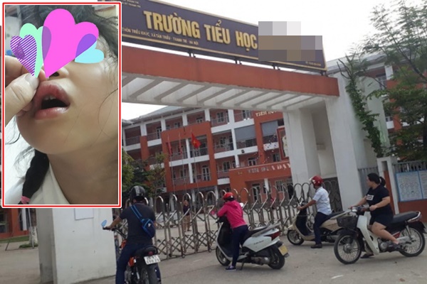 Nam Định: Yêu cầu cô giáo kiểm điểm sau sự việc bé gái bị đánh bầm tím cánh tay vì viết bài chậm-3