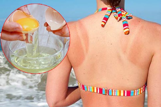 Áp dụng 5 cách chăm sóc da bị cháy nắng đơn giản giúp da lên tông nhanh chóng