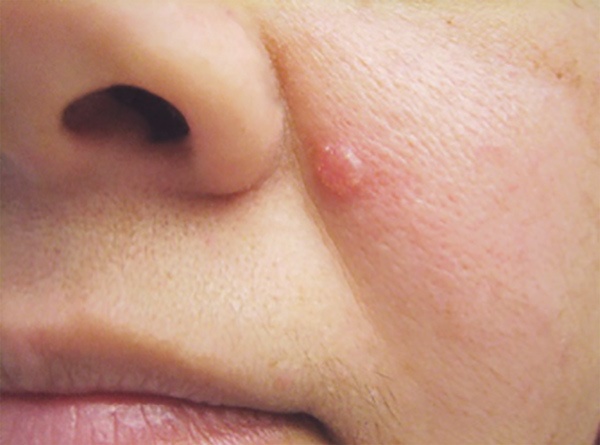 Ba dấu hiệu dễ bỏ qua giúp phát hiện sớm ung thư da-1