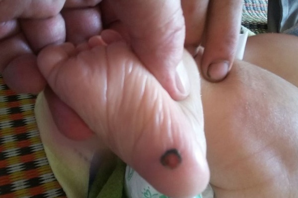 Bé 1 tháng tuổi mắc bệnh giang mai bẩm sinh do lây từ mẹ-1