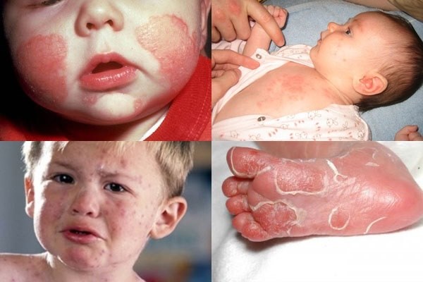 Bệnh giang mai bẩm sinh nguy hiểm thế nào, có chữa được không?-2