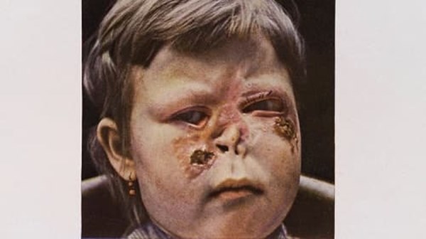 Bệnh giang mai bẩm sinh nguy hiểm thế nào, có chữa được không?-3