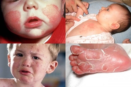 Bệnh giang mai bẩm sinh nguy hiểm thế nào, có chữa được không?
