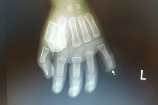 Trẻ 17 tháng tuổi bị cứa đứt rời đốt ngón tay do nghịch dao từ sự bất cẩn của cha mẹ-1