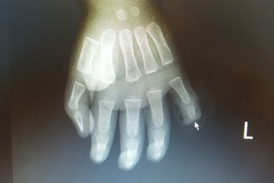 Trẻ 17 tháng tuổi bị cứa đứt rời đốt ngón tay do nghịch dao từ sự bất cẩn của cha mẹ