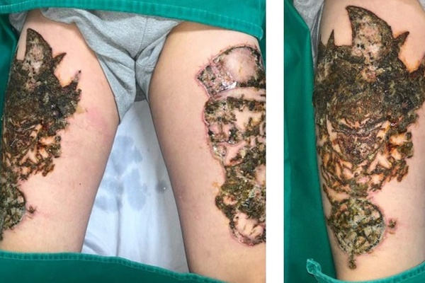 Nhập viện sau 4 ngày xóa xăm-1