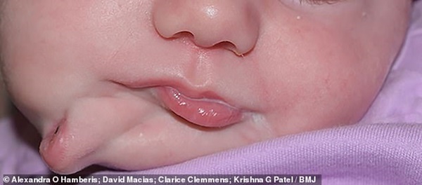 Vừa mới chào đời, bé gái đã khiến các bác sĩ kinh ngạc khi có đến 2 cái miệng trên mặt - bệnh lý vô cùng hiếm gặp-1