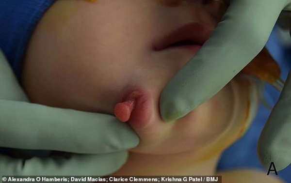Vừa mới chào đời, bé gái đã khiến các bác sĩ kinh ngạc khi có đến 2 cái miệng trên mặt - bệnh lý vô cùng hiếm gặp-2