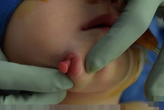 Vừa mới chào đời, bé gái đã khiến các bác sĩ kinh ngạc khi có đến 2 cái miệng trên mặt - bệnh lý vô cùng hiếm gặp