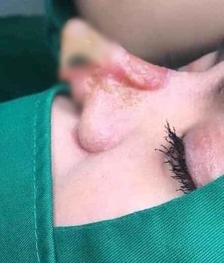 Hàng loạt biến chứng đáng sợ khi nâng mũi, nhìn thôi cũng thấy đau rụng rời: Chị em muốn can thiệp dao kéo cần rút kinh nghiệm ngay!-1