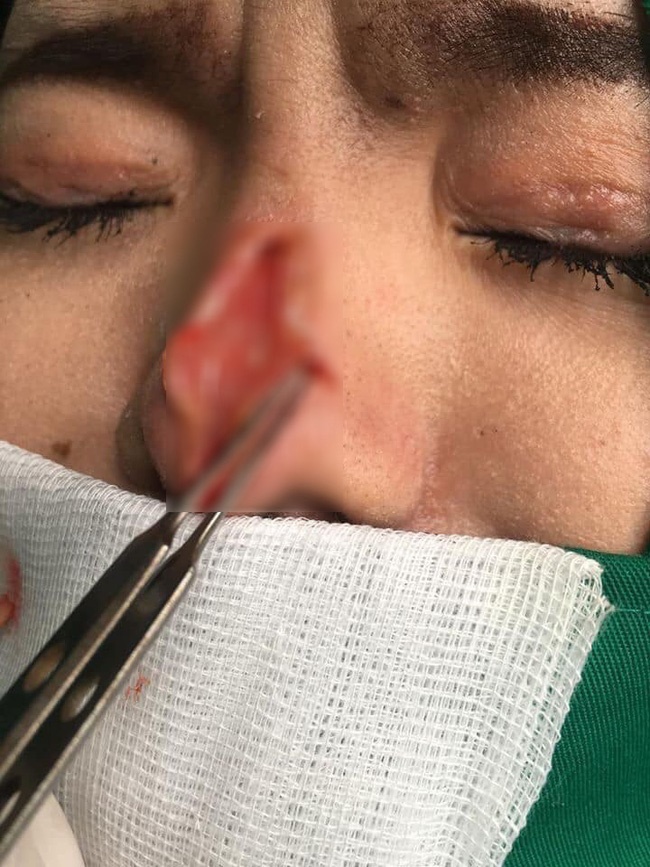 Hàng loạt biến chứng đáng sợ khi nâng mũi, nhìn thôi cũng thấy đau rụng rời: Chị em muốn can thiệp dao kéo cần rút kinh nghiệm ngay!-2