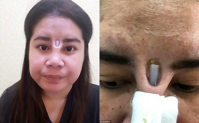 Hàng loạt biến chứng đáng sợ khi nâng mũi, nhìn thôi cũng thấy đau rụng rời: Chị em muốn can thiệp dao kéo cần rút kinh nghiệm ngay!-4