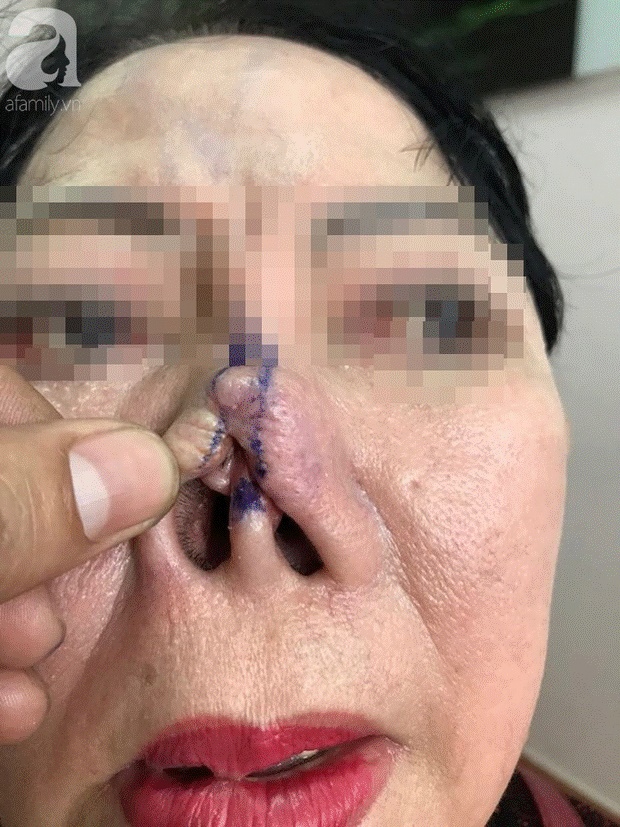 Hàng loạt biến chứng đáng sợ khi nâng mũi, nhìn thôi cũng thấy đau rụng rời: Chị em muốn can thiệp dao kéo cần rút kinh nghiệm ngay!-6