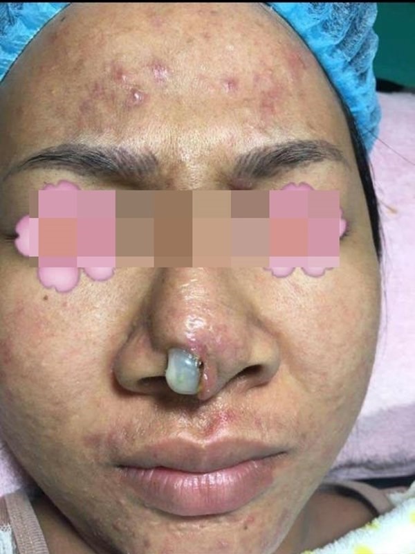 Hàng loạt biến chứng đáng sợ khi nâng mũi, nhìn thôi cũng thấy đau rụng rời: Chị em muốn can thiệp dao kéo cần rút kinh nghiệm ngay!-7