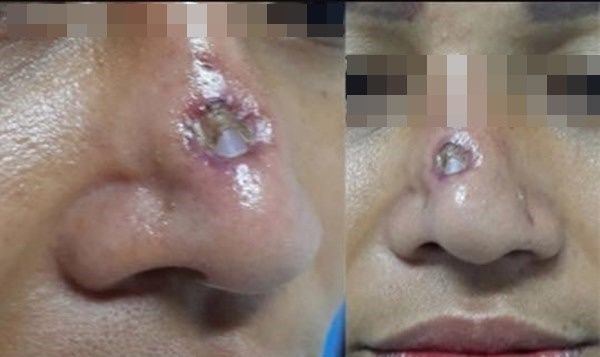 Hàng loạt biến chứng đáng sợ khi nâng mũi, nhìn thôi cũng thấy đau rụng rời: Chị em muốn can thiệp dao kéo cần rút kinh nghiệm ngay!-8