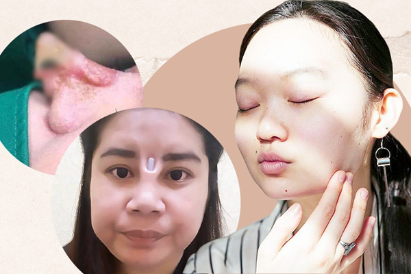 Cô gái toang hết phần mũi vì spa chữa đi chữa lại đến 4 lần-4
