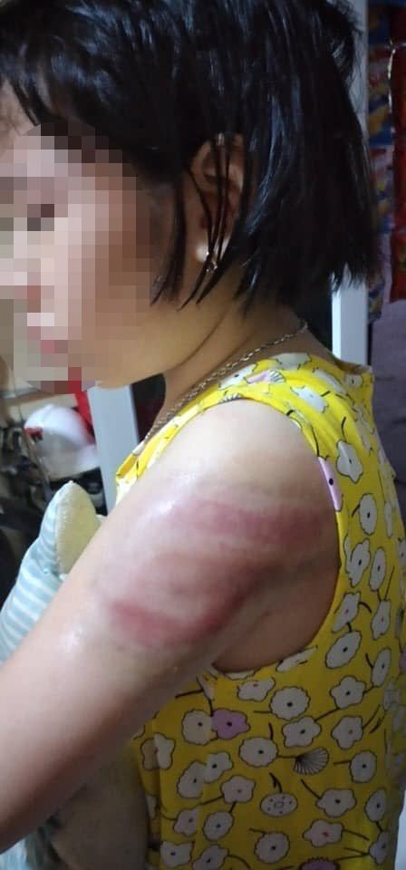 Thêm 1 vụ giáo viên bạo hành học sinh, phụ huynh bức xúc tố: Cháu bị cô đánh bầm tay  vì viết bài chậm, sợ quá không dám kể với ai!-1