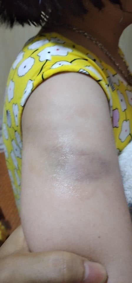 Thêm 1 vụ giáo viên bạo hành học sinh, phụ huynh bức xúc tố: Cháu bị cô đánh bầm tay  vì viết bài chậm, sợ quá không dám kể với ai!-2