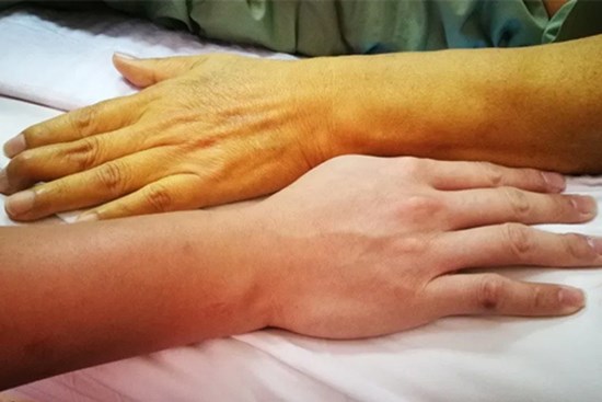 Màu da thay đổi hé lộ nhiều bệnh nguy hiểm