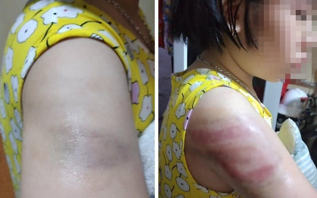 Nam Định: Yêu cầu cô giáo kiểm điểm sau sự việc bé gái bị đánh bầm tím cánh tay vì viết bài chậm-1