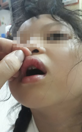 Nam Định: Yêu cầu cô giáo kiểm điểm sau sự việc bé gái bị đánh bầm tím cánh tay vì viết bài chậm-2