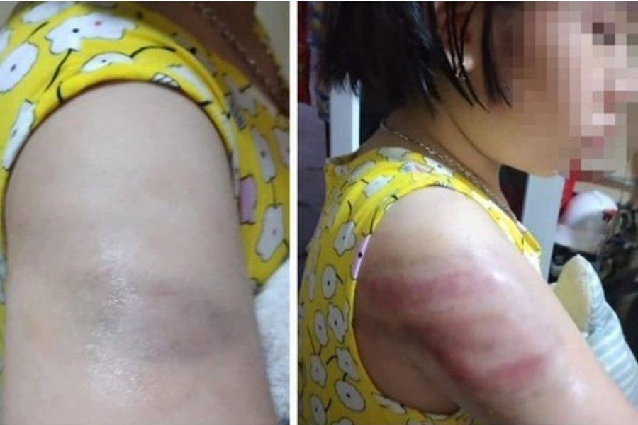 Bản tường trình của cô giáo trẻ đánh học sinh bầm tím tay-1