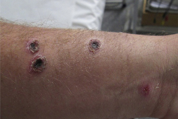 Điện Biên ghi nhận ca bệnh than thứ 14 không rõ nguồn lây-2