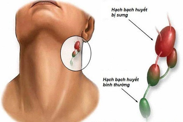 Nếu cơ thể xuất hiện 1 chậm 2 lồi 3 nhiều”, cảnh báo bệnh phổi đang tìm đến bạn-2