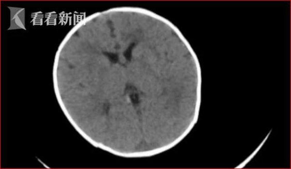 Bé 2 tháng tuổi bị xuất huyết não, mẹ sững sờ khi biết do thói quen ăn uống của mình-1