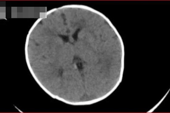 Bé 2 tháng tuổi bị xuất huyết não, mẹ sững sờ khi biết do thói quen ăn uống của mình