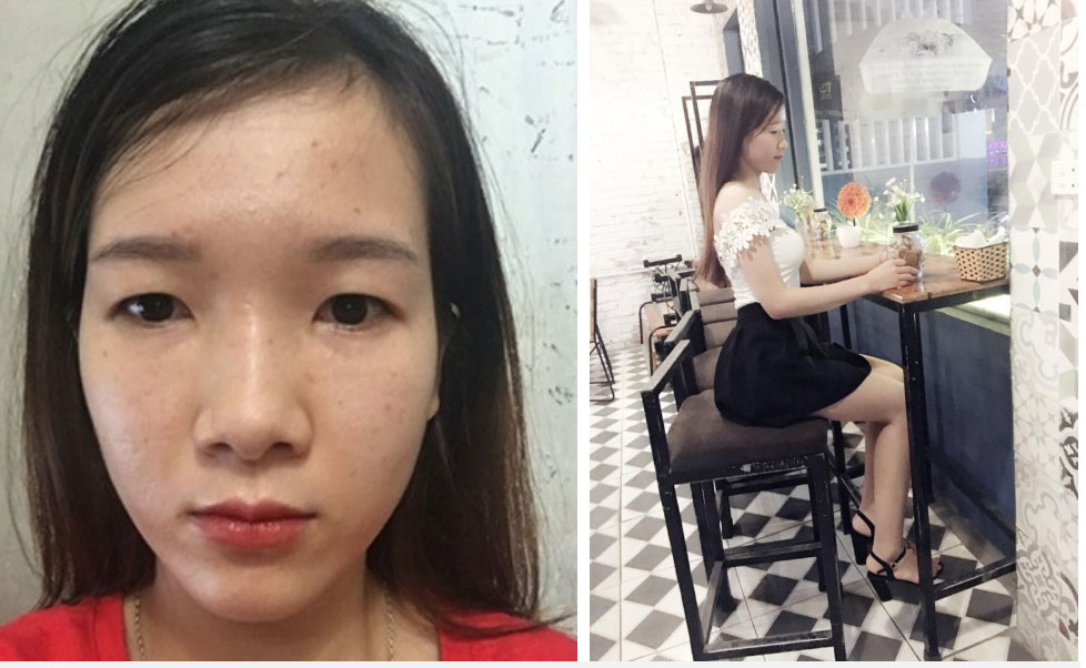 Cô gái dân tộc từng bị miệt thị bởi ti hí mắt lươn sau 3 năm dao kéo đổi đời: Ngày càng xinh đẹp như búp bê, vừa kết hôn với chồng bác sĩ-3