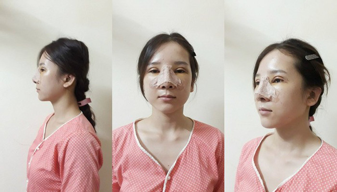 Cô gái dân tộc từng bị miệt thị bởi ti hí mắt lươn sau 3 năm dao kéo đổi đời: Ngày càng xinh đẹp như búp bê, vừa kết hôn với chồng bác sĩ-4