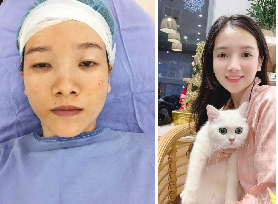 Cô gái dân tộc từng bị miệt thị bởi ti hí mắt lươn sau 3 năm dao kéo đổi đời: Ngày càng xinh đẹp như búp bê, vừa kết hôn với chồng bác sĩ-5