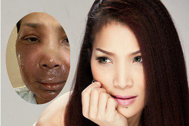 Hồng Ngọc đăng ảnh rõ nét sau 1 tháng bị bỏng nặng, tình trạng thế nào mà dàn sao Vbiz liên tục chúc mừng?-2