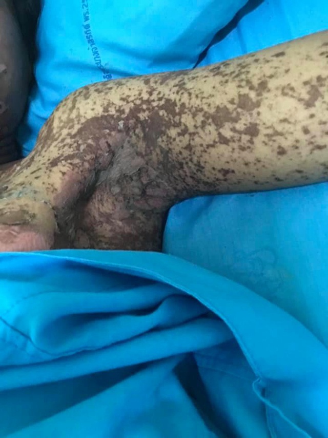 Sốc với hình ảnh cô gái bị dị ứng toàn thân, mặt biến dạng do dùng thuốc chữa đau răng khiến nhiều người thấy sợ-3