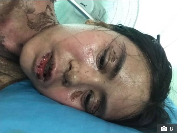 Sốc với hình ảnh cô gái bị dị ứng toàn thân, mặt biến dạng do dùng thuốc chữa đau răng khiến nhiều người thấy sợ-4