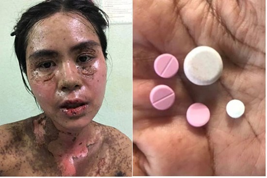 Sốc với hình ảnh cô gái bị dị ứng toàn thân, mặt biến dạng do dùng thuốc chữa đau răng khiến nhiều người thấy sợ