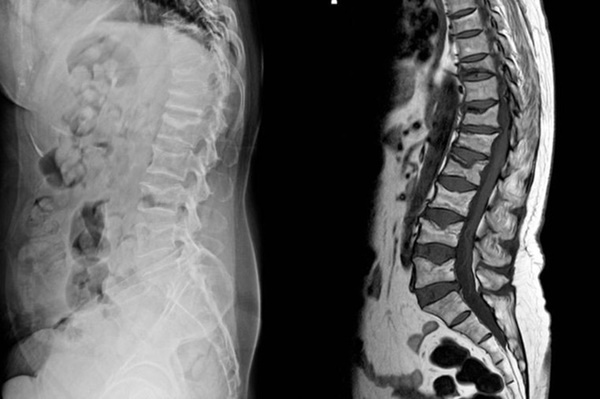 7 bệnh nghiêm trọng sau dấu hiệu của cơn đau lưng-3