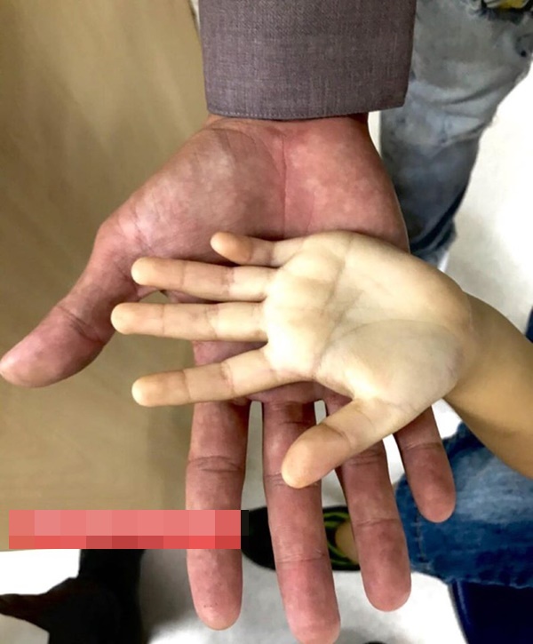 Hình ảnh bàn tay của bé gái uống hơn 10 hộp sữa tươi mỗi ngày khiến ai cũng giật mình-1