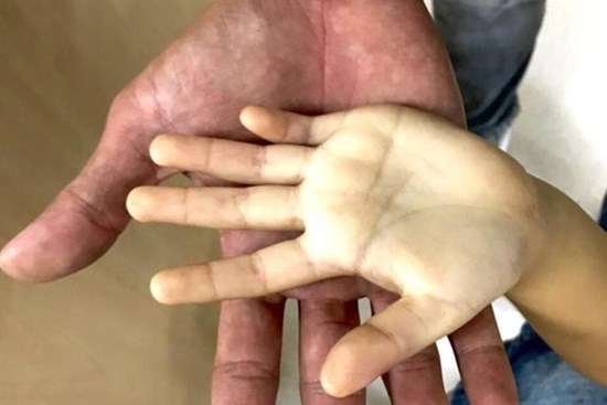 Hình ảnh bàn tay của bé gái uống hơn 10 hộp sữa tươi mỗi ngày khiến ai cũng giật mình