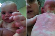 Bé 4 tháng tuổi bị sốc phản vệ sau khi uống 40ml sữa công thức khiến người mềm nhũn, tấy đỏ