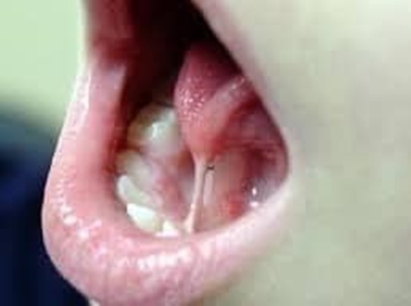 Trẻ chậm nói, khó phát âm, nói ngọng, chỉ nói được vài từ đơn giản: Nguyên nhân có thể do mắc dị tật này-2