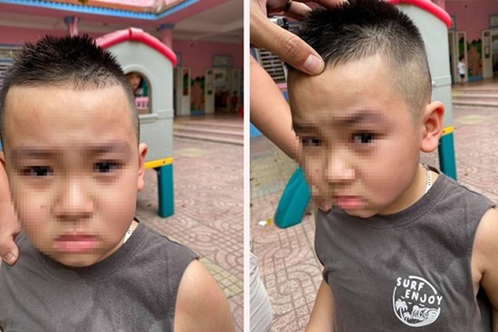 Vụ việc gây bức xúc: Con đi học mẫu giáo bị bạn cấu xước mí mắt, phụ huynh đến tận trường tát thẳng mặt trẻ trước mặt cô giáo