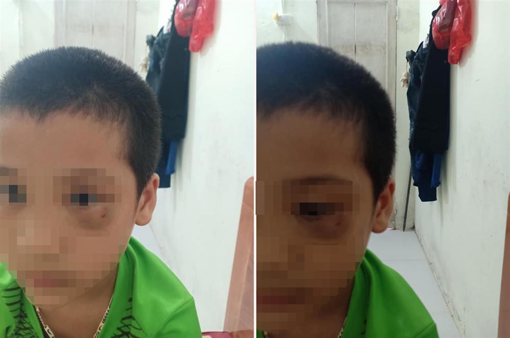 Vụ phụ huynh tát trẻ mẫu giáo: Người mẹ chính thức xin lỗi, công khai luôn ảnh đôi mắt bầm tím của con mình-2