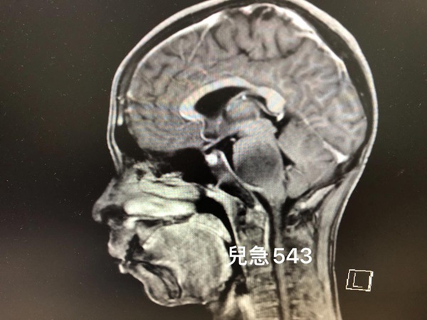 Con trai bị nhức đầu, liệt mặt, nuốt khó, đến bệnh viện khám ông bố sốc khi nghe chẩn đoán từ bác sĩ-1