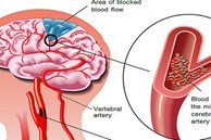 Căn bệnh 'sát thủ' có thể gây suy tim, đột quỵ, suy thận: Nguy hiểm nhưng khó phát hiện