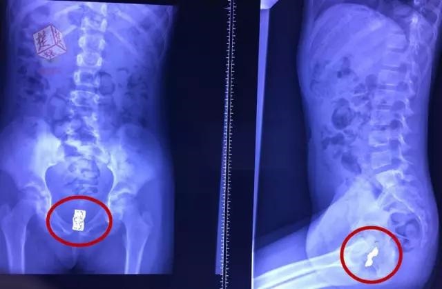 Vùng kín của con gái 8 tuổi liên tục chảy mủ, bốc mùi, bố mẹ choáng váng khi bác sĩ lấy ra thứ này bên trong-2